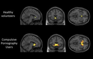 YBOP (your brain on porn) brain study