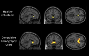 Area of the brain lighting up more in those subjects who watch excessive porn compared with control group